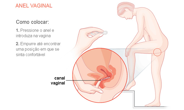 Anel vaginal Anel vaginal