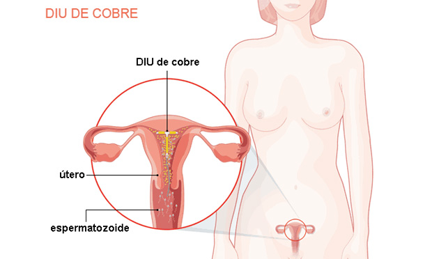 DIU de cobre DIU de cobre