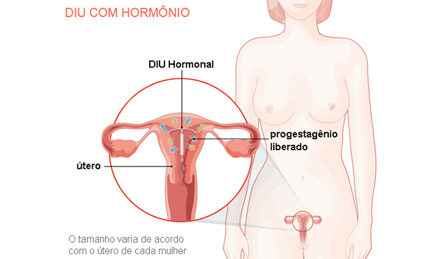 DIU com hormônio