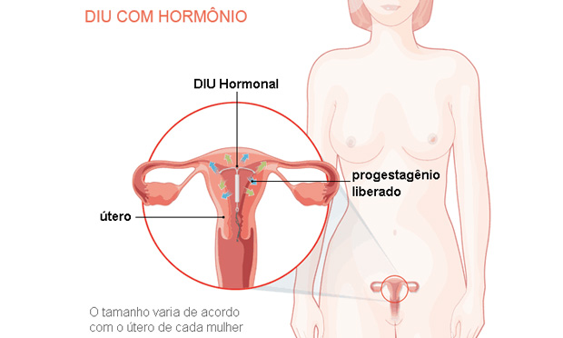 DIU com hormônio DIU com hormônio