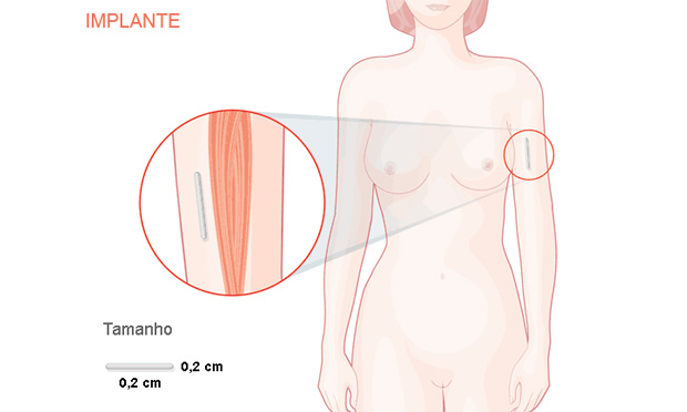 Implante Implante