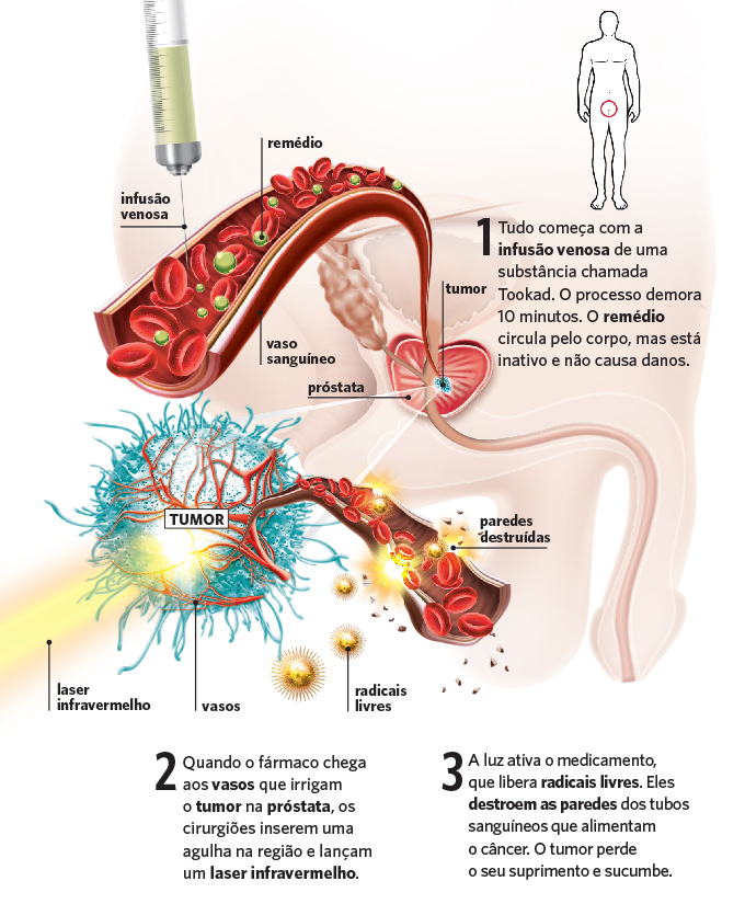 adenocarcinoma prostata tratamento)