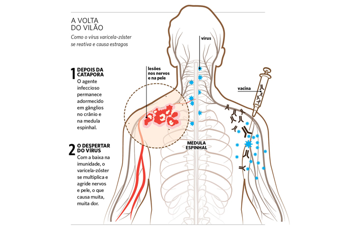 A ascensão do herpes-zóster