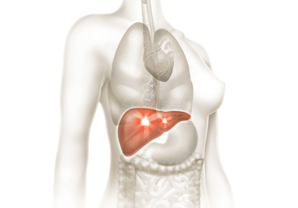 gordura no fígado, esteatose hepática não alcoólica dieta exercício laser infravermelho