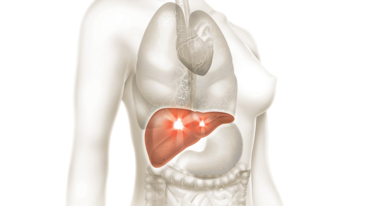 gordura no fígado, esteatose hepática não alcoólica dieta exercício laser infravermelho