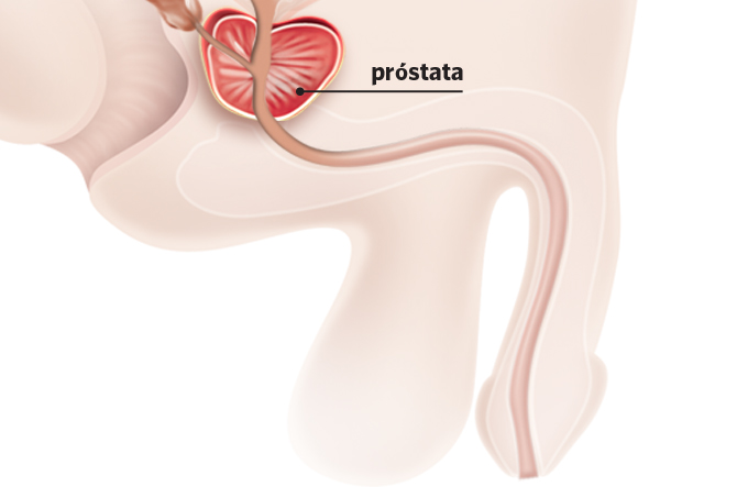 cancer prostata tratamento injeção