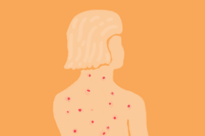 Catapora: sintomas, manchas vacina e sinais em adultos