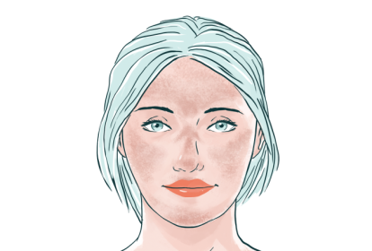 melasma