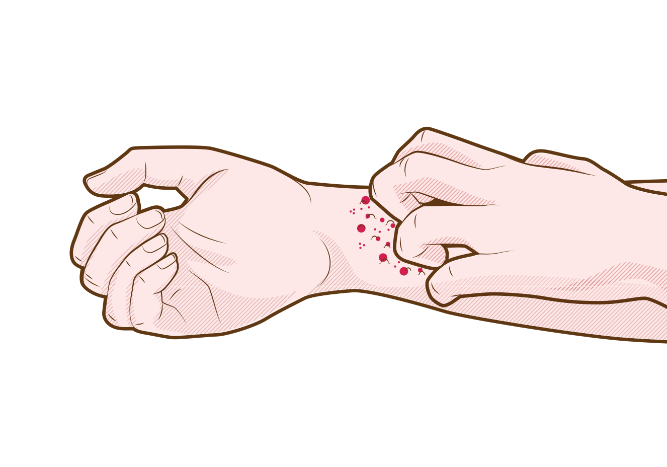 artrita infecțioasă a degetului