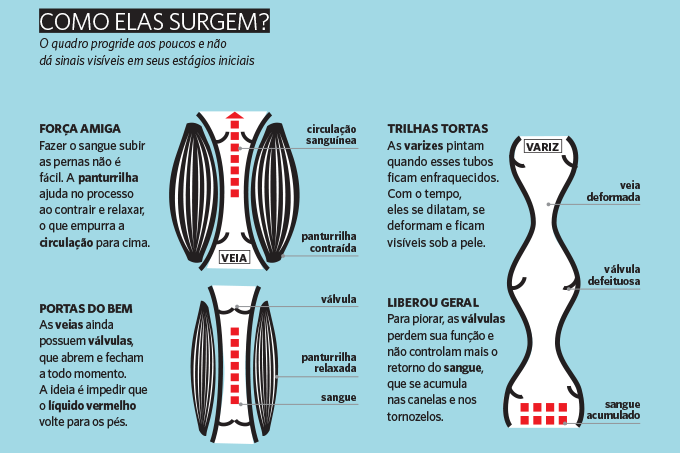 Como surgem as varizes?