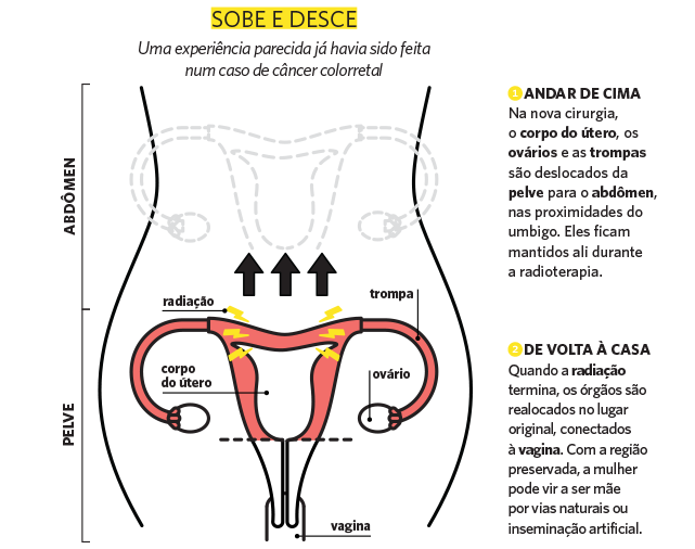 Cirurgia de Anexos Uterinos: Ovários e Trompas - Mastologista e  Oncoginecologista