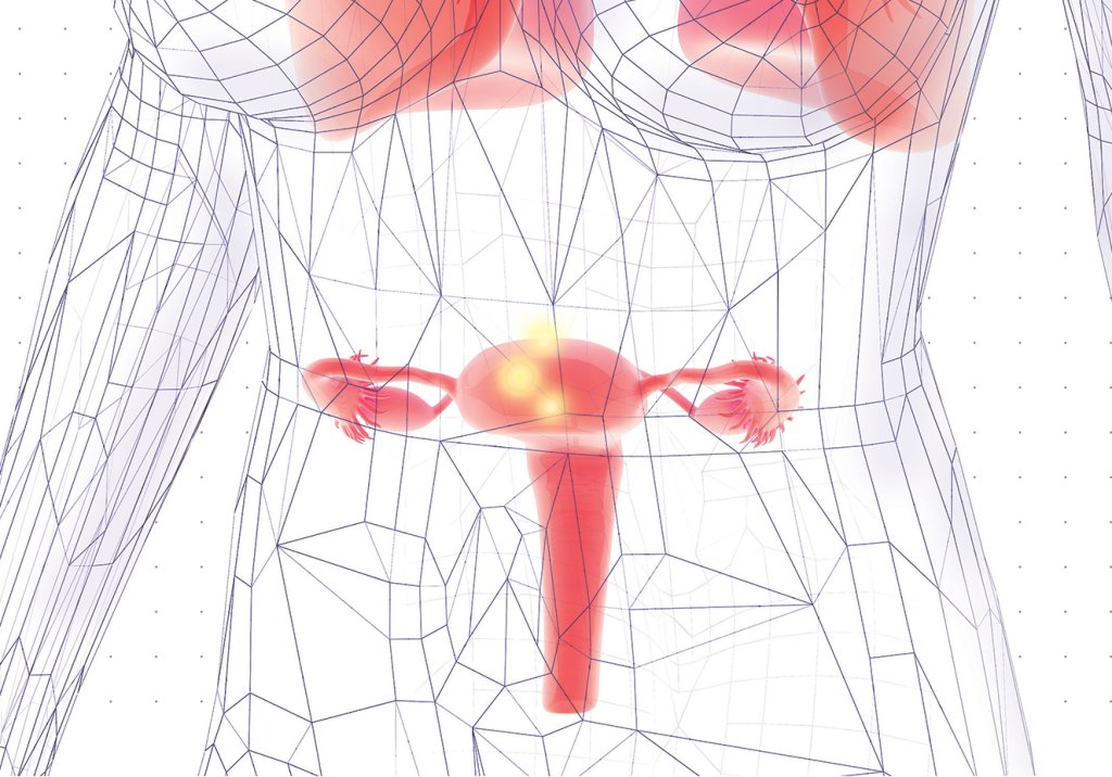 cancer de colo de utero