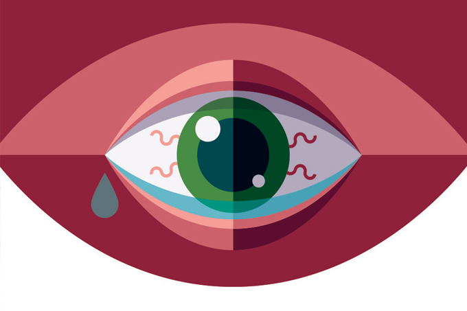 uveíte ocular: sintomas, tratamento e remédio