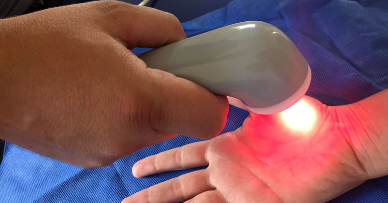 tratamento para fibromialgia com laser na mão