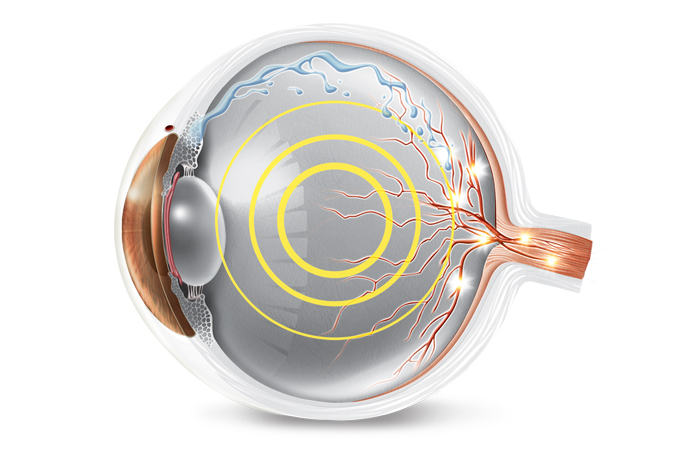 tratamento com laser para glaucoma