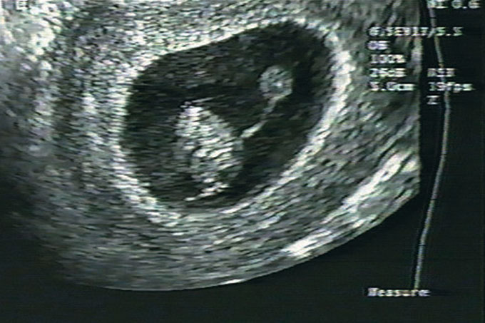 Sofrimento fetal pode ser detectado durante o pré-natal