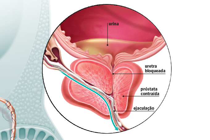 SQS gráfico próstata