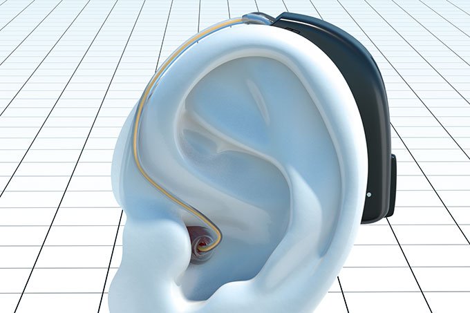 Surdez: Novo aparelho auditivo oferece tradução em tempo real e alerta de  quedas