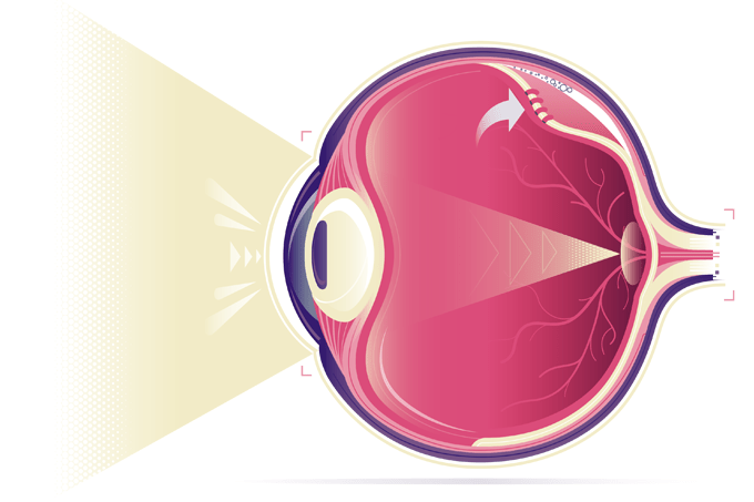 cirurgia de descolamento de retina