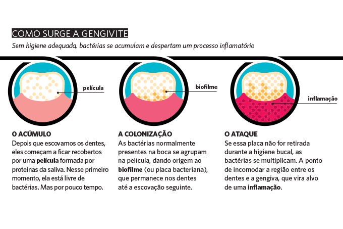 O que é a gengivite? Saiba como prevenir e tratar | Veja Saúde