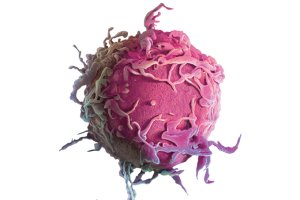 Pandemia de coronavírus traz impactos no diagnóstico e no tratamento do câncer