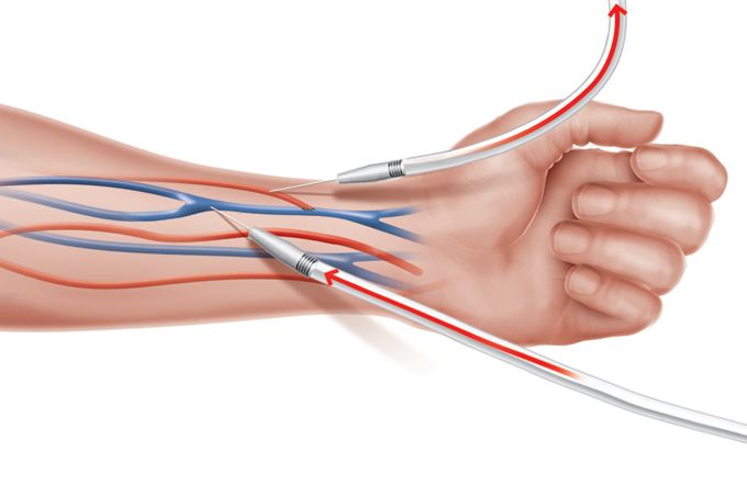hemodialise para doença renal cronica