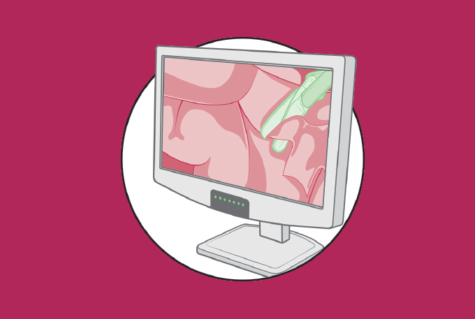 videolaparascopia 4 monitor de cirurgia