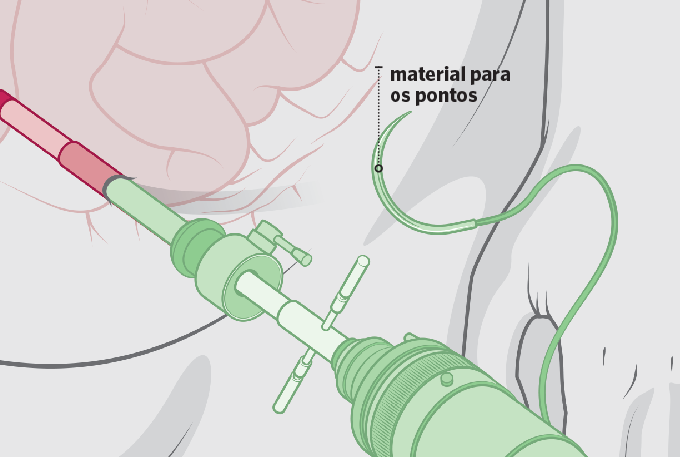 videolaparascopia 5 pontos para sutura na cirurgia