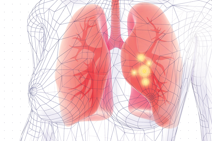 Sintomas de pneumonia: quais são, diagnóstico e tratamento