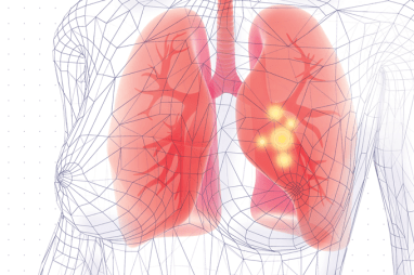 Desenho de pulmão com pneumonia