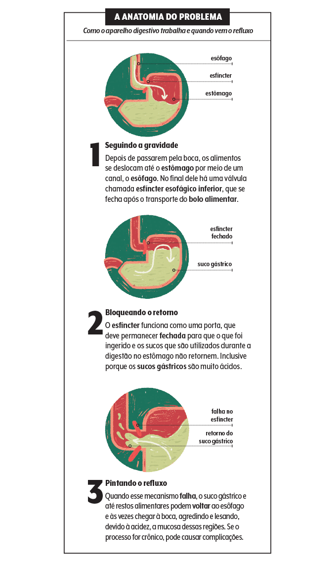 Infográfico sobre como funciona o refluxo