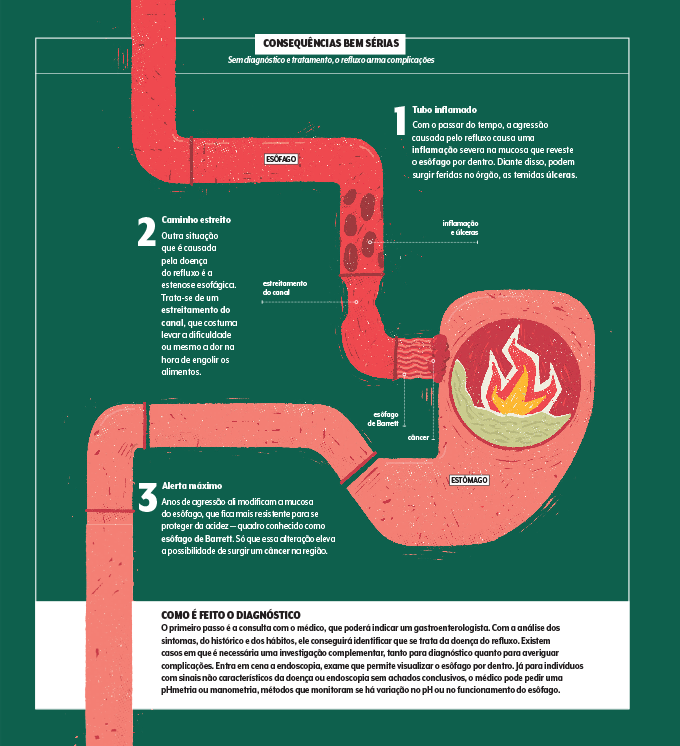 Infográfico sobre complicações do refluxo