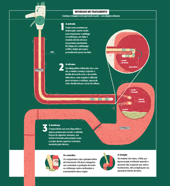 Infográfico sobre cirurgia para refluxo