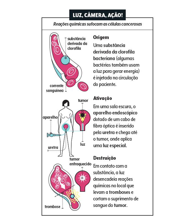 Terapia fotodinâmica