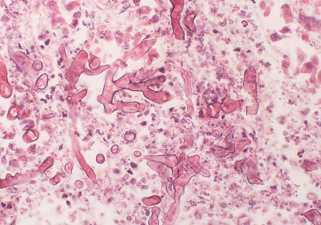 imagem de microscópio mostrando fungo causador da micormicose, doença do fungo negro