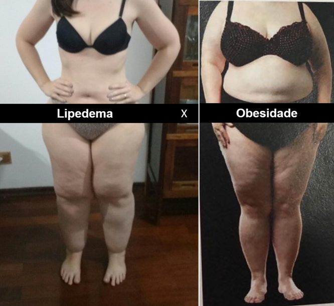 mulher com lipedema e mulher com obesidade