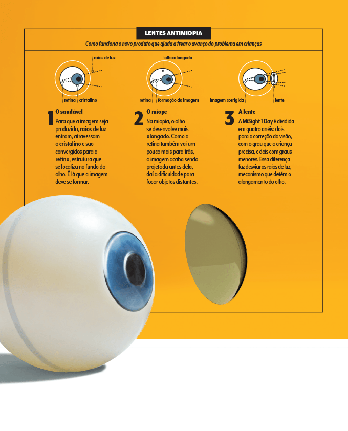 Esquema passo a passo de como funcionam as lentes de contato que tratam miopia em crianças