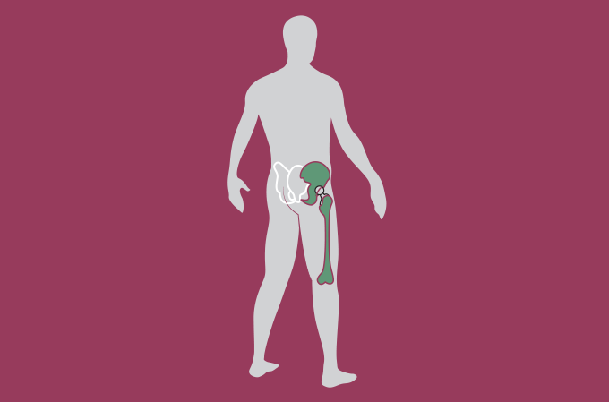 cirurgia-de-protese-de-quadril