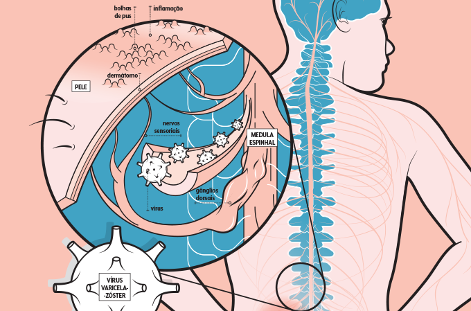 como surge o herpes-zoster