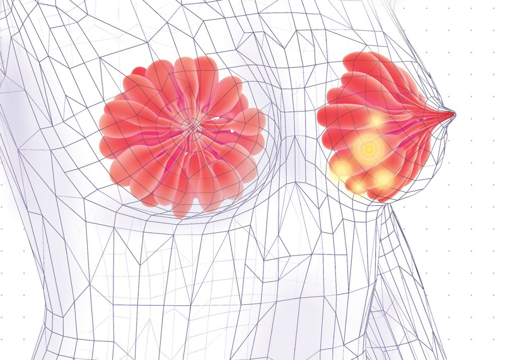 Promessa brasileira para o tratamento do câncer de mama mais agressivo