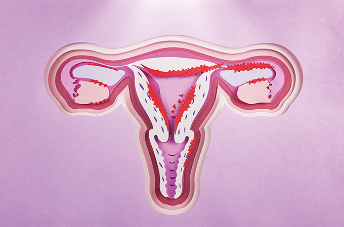 causas da endometriose