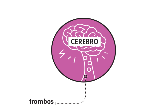 Cérebro com trombos provocados pela hipertensão