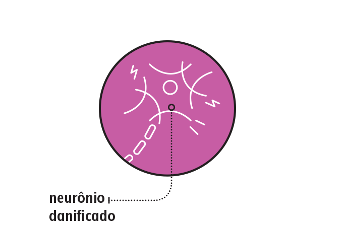 Neurônio afetado por microtrombo