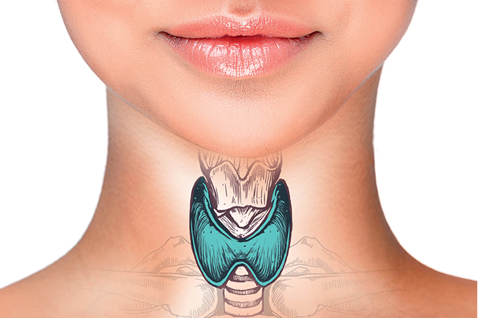 ilustração de tireoide no pescoço de uma mulher, sinalizando câncer de tireoide