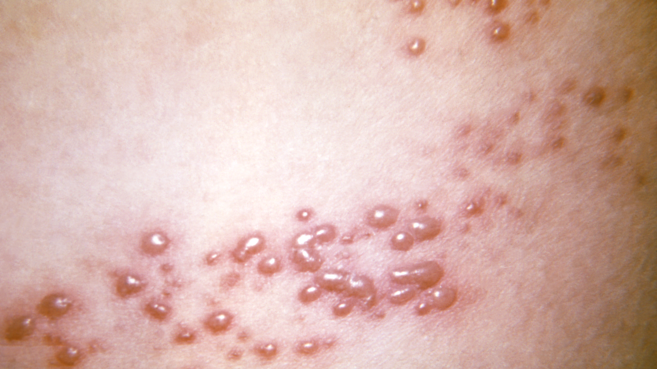 Imagem que mostra exemplo de lesão do herpes-zóster na pele