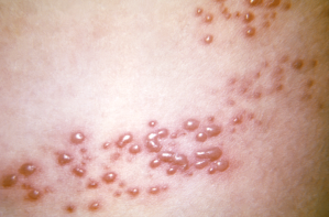 Imagem que mostra exemplo de lesão do herpes-zóster na pele