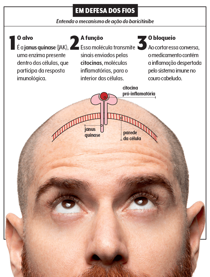 baricitinibe e alopecia areata