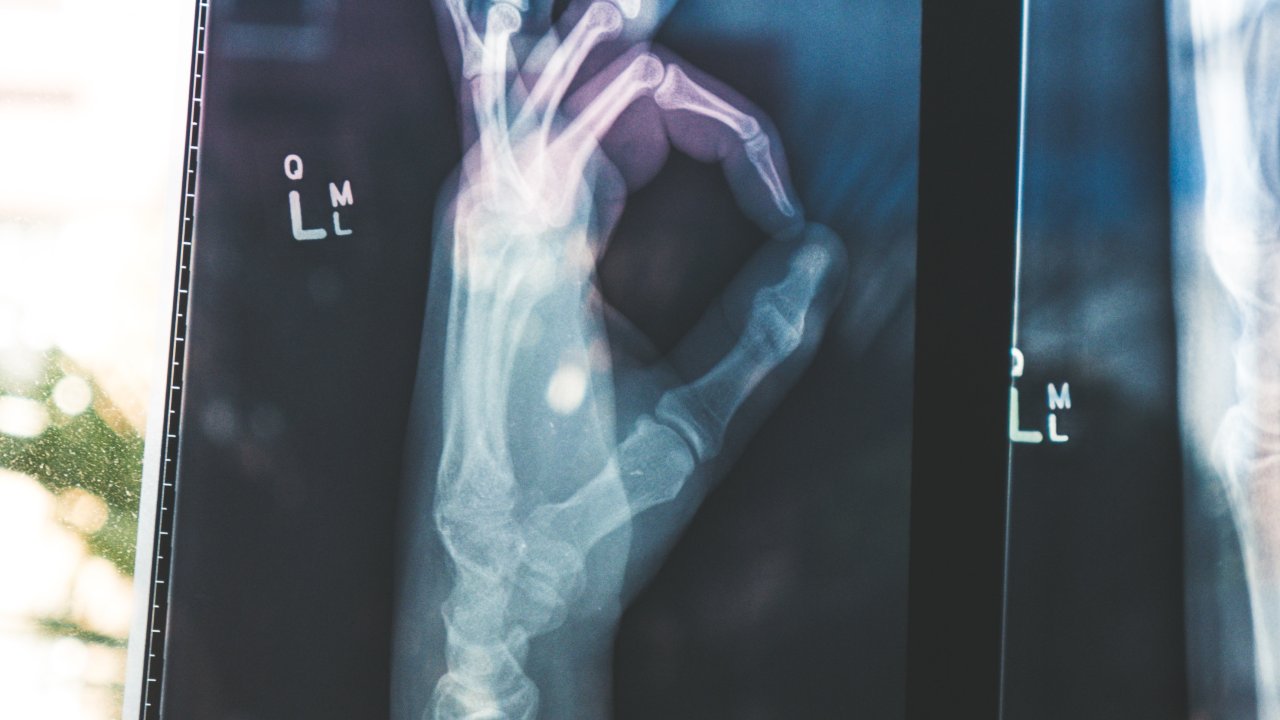 Foto de raio-x com mão fazendo sinal de ok