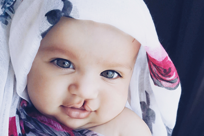 foto de bebê com lábio leporino