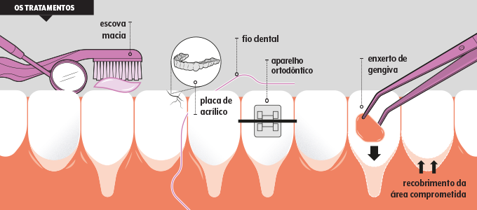 tratamentos retração gengival